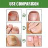 10ML Health Toenail Stick Roller Bead Onychomycosis Care Solution for Women Men