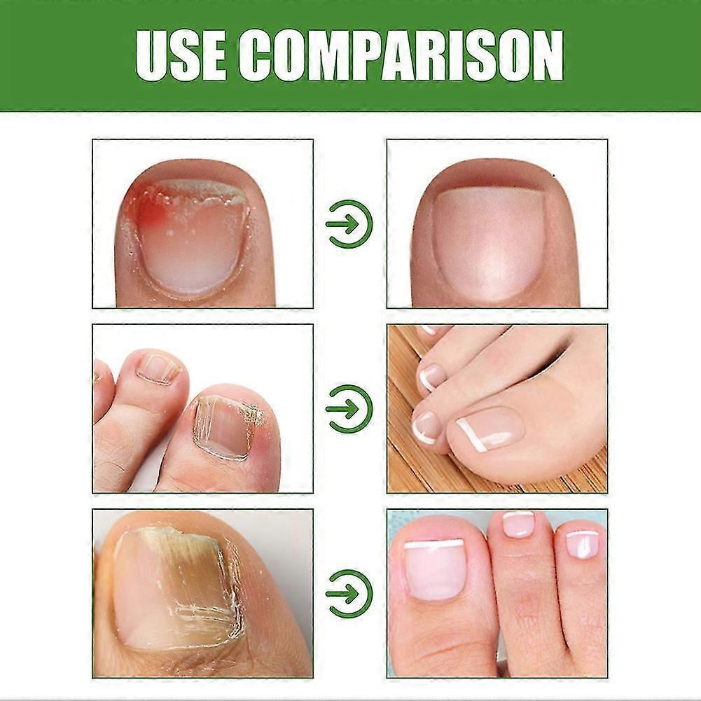 10ML Health Toenail Stick Roller Bead Onychomycosis Care Solution for Women Men