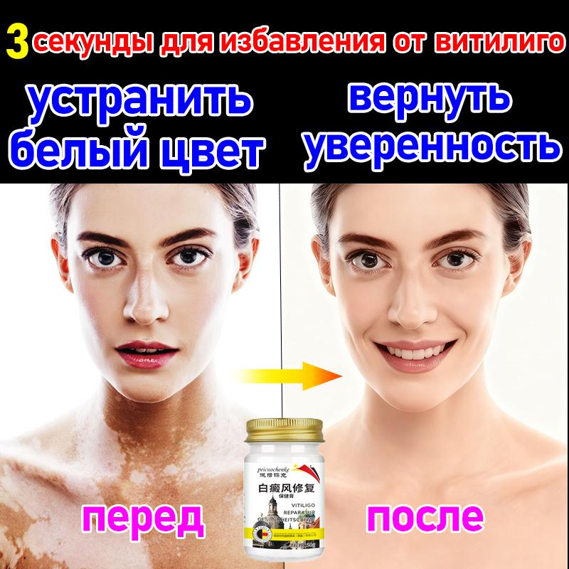 

Petroschenk Vitiligo Ointment White Spot Sweat Spot Skin Disease Special Ointment