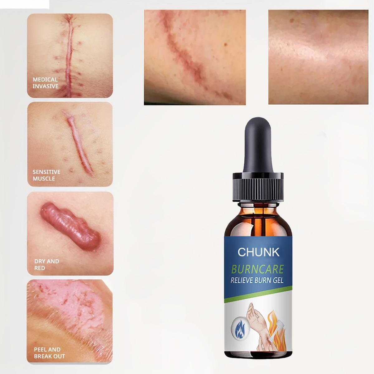 

5 г/15 г/30 г/50 г/удаление растяжек, целлюлита и шрамов