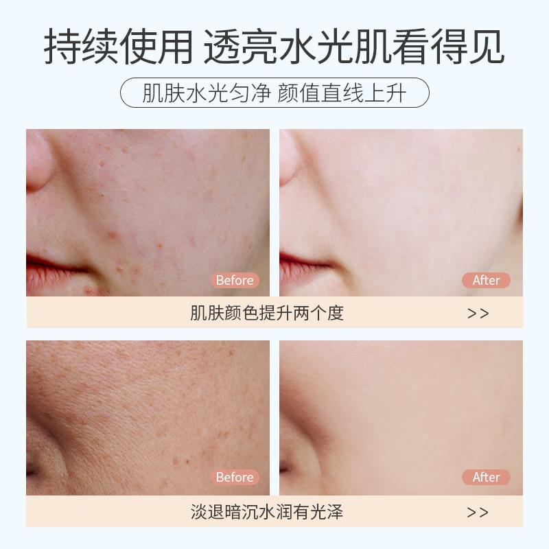Ruyi Nicotinamide facial mask for women hydrating and moisturizing, improving dull, shrinking pores, tightening and removing acne marks