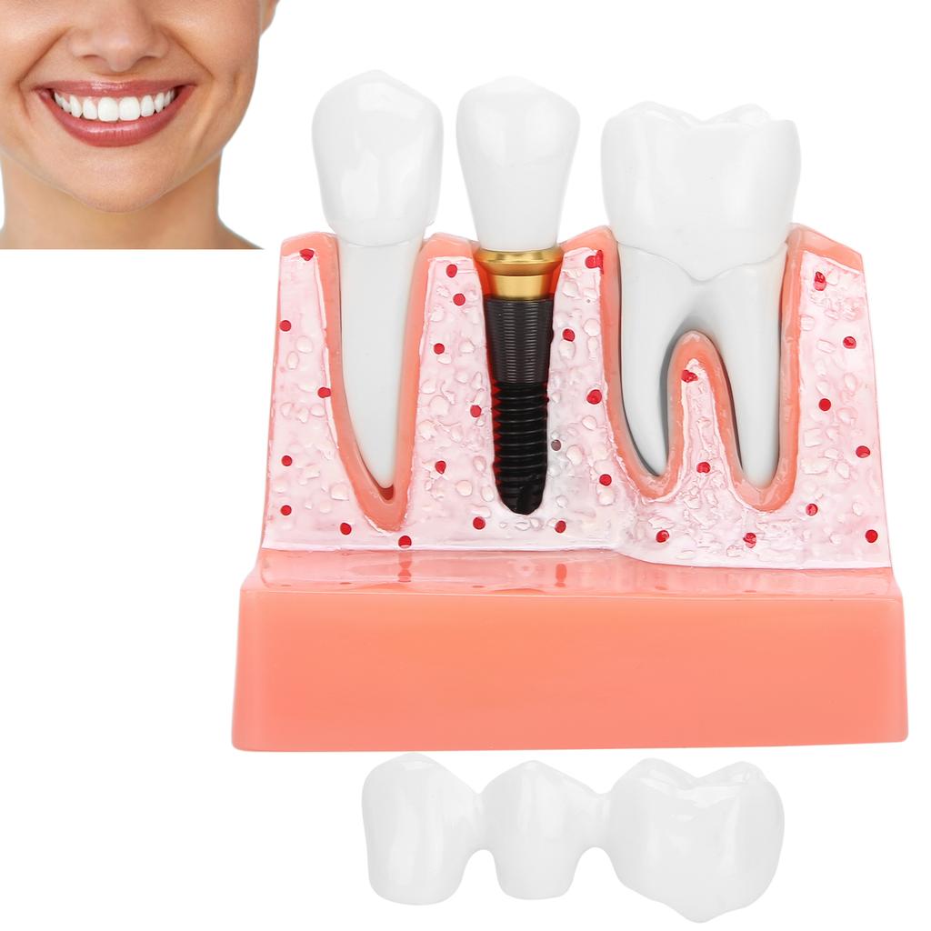 Model zubů Analýza zubního implantátu Demonstrační model korunkového můstku Model zubu