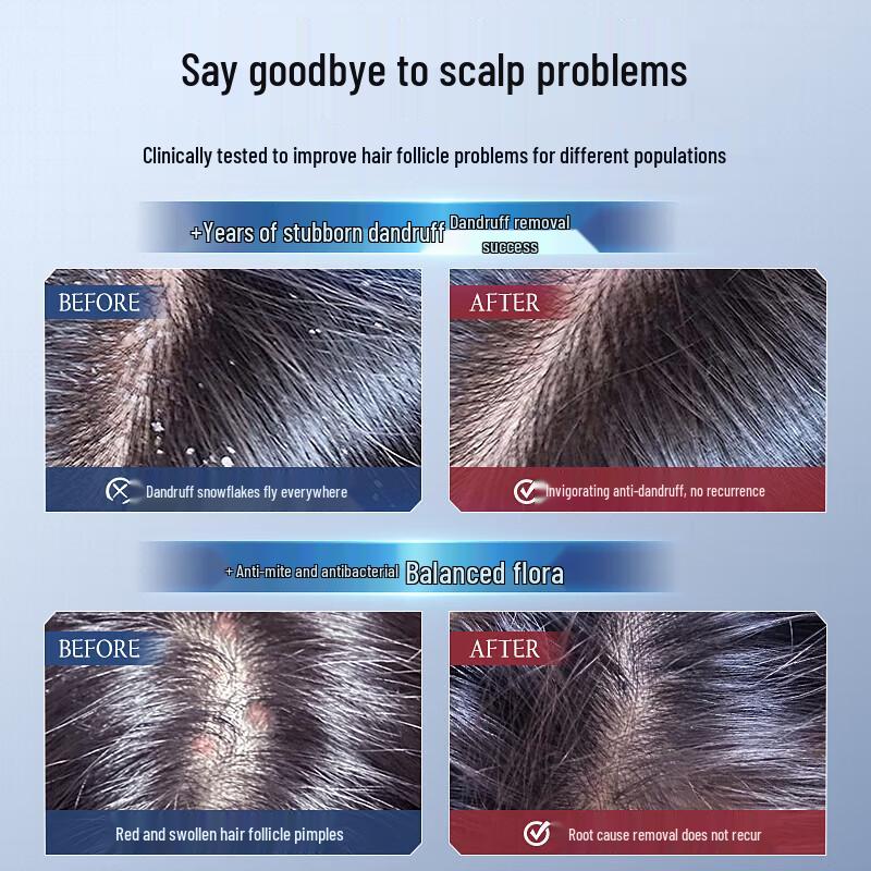 Vithair Selenium Sulfide Anti-Dandruff Shampoo