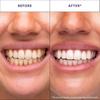 V34 Purple Whitening Teeth Strips Whitens After One Use, Whitening and Colour Correction, Gentle Formula Enamel Protection