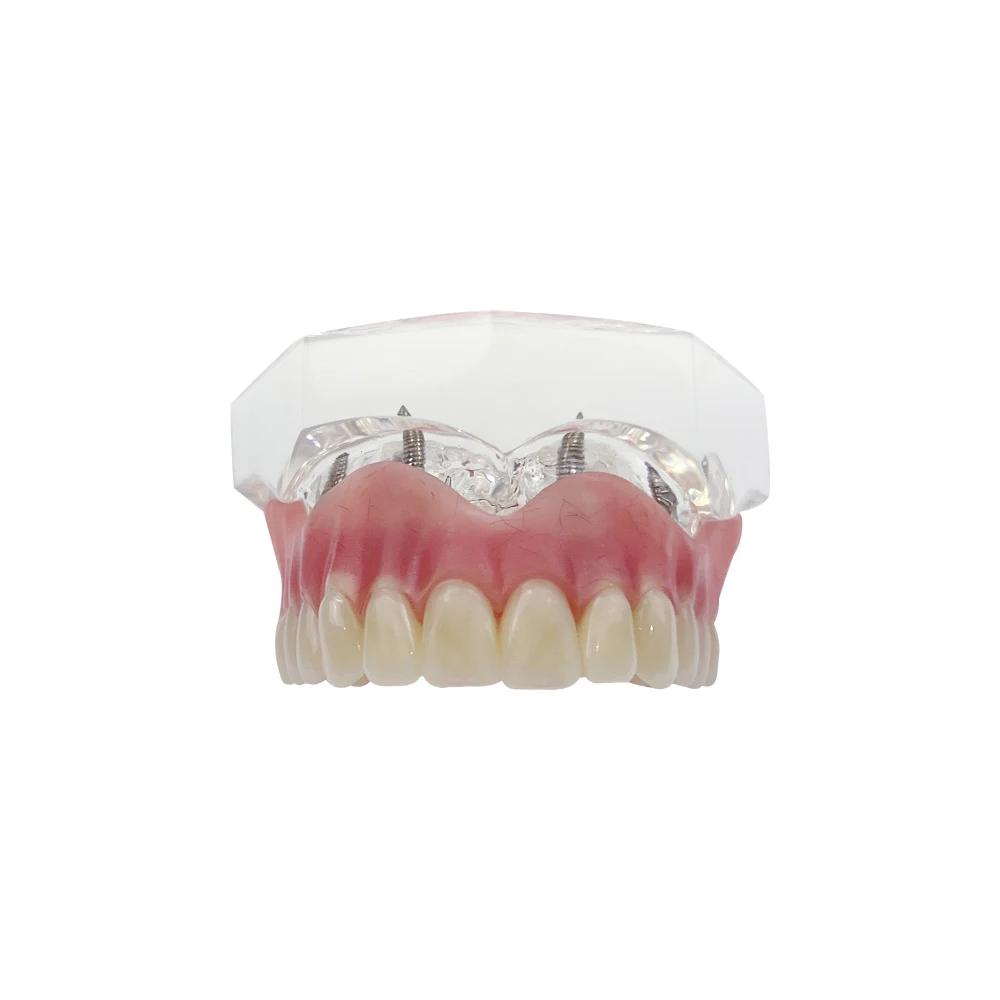 Upper Lower Dental Implant Teeth Model Clear Dental Model Teeth Implant Restoration Bridge Removable For Education Teaching Demo
