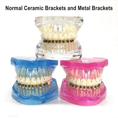 1-częściowy model dentystycznych ortodontycznych przezroczystych zębów z normalnymi wspornikami ceramicznymi i metalowymi oraz zestawami do komunikacji z pacjentem