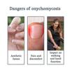 2025 Latest Model Nail Fungus Treatment Device, Embedded Light Therapy for Thickened Nails, Portable LED Home Foot Care Equipment