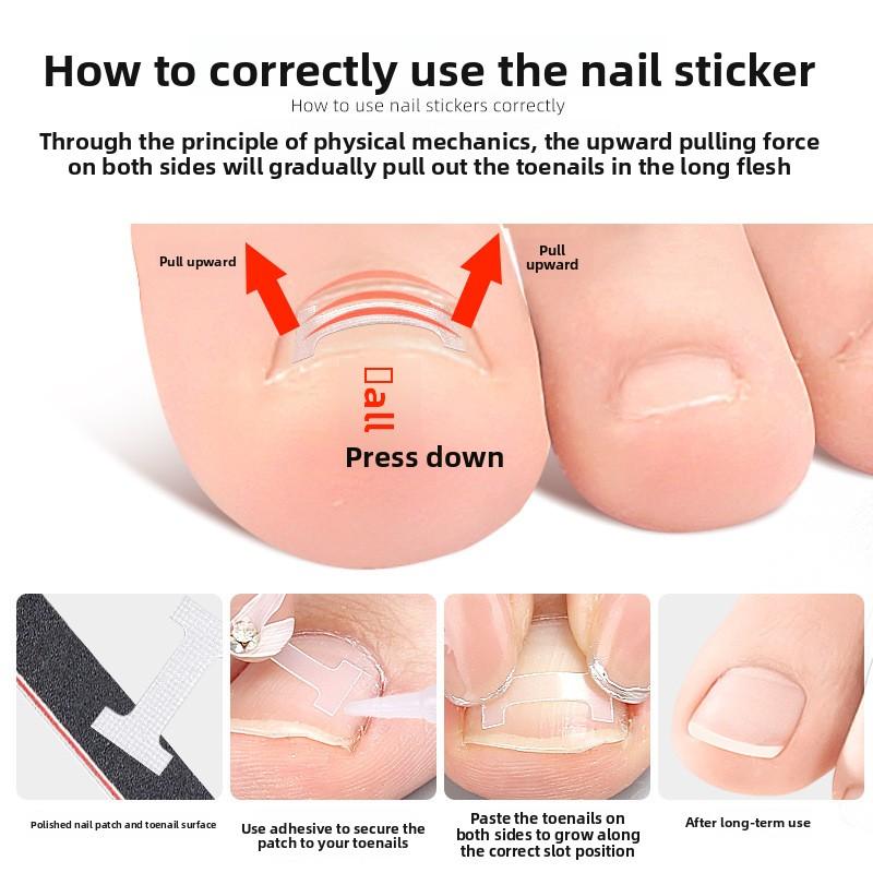 I-shaped Inlaid Nail Positive Nail Sticker Physical Stretching Patch Pull Nail Groove Curl Nail Small Invisible Shoes Can Walk