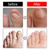 10ml Nail Essence Fast Absorption Protect Painless Reduce Dry Quick Effect Onychomycosis Heal Pedicure Care Nail Fungus Treatment Feet Care Essence