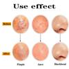 Ultra-fine Cell Pimples Blackhead Clip Tweezers Beauty Salon Remover Acne Needle Blackhead Deep Cleaner Clip Face Skin Care