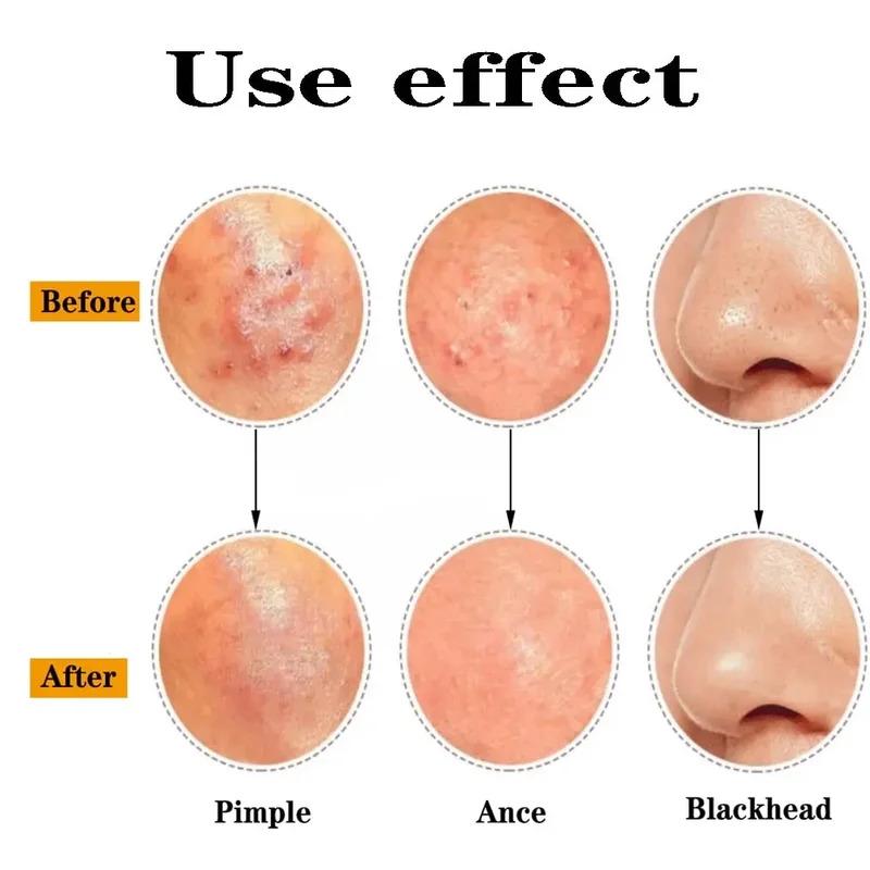 Ultra-fine Cell Pimples Blackhead Clip Tweezers Beauty Salon Remover Acne Needle Blackhead Deep Cleaner Clip Face Skin Care
