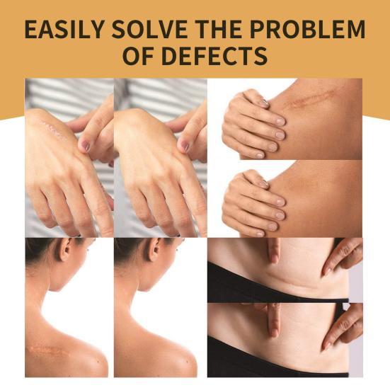 Yousheng 6 Stück/Box Tattoo Hidden Tape Gesund Schmerzlos Mild Sicher Wasserdicht Einfach zu verwenden Sanftes Narben-Tattoo-Abdeckungspflaster für Mädchen