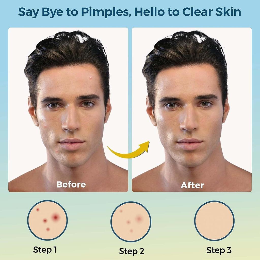 Spruce Shave Club Acne Pimple Patches for Face (72 Acne Patches for Pimples)