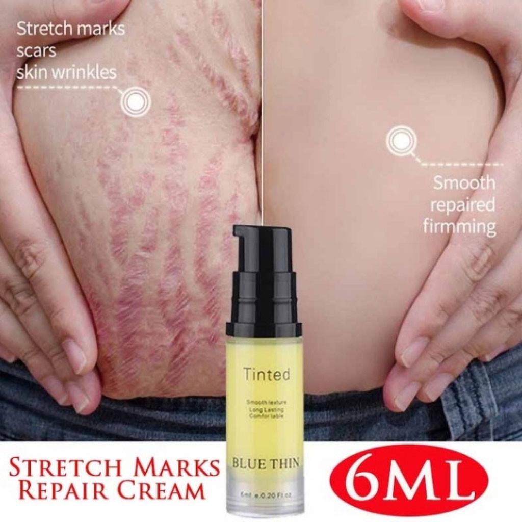 

Удаление Рамидоса, шрамы от прыщей, растяжки, шрамы, стрии беременных