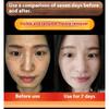 Whitening and Freckle Removing Cream Face Cream Lightening and Removing Spotles Sunburn Brightening Skin Color