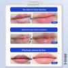 Feuchtigkeitsspendender Lippenbalsam für trockene, rissige Lippen & Cheilitis