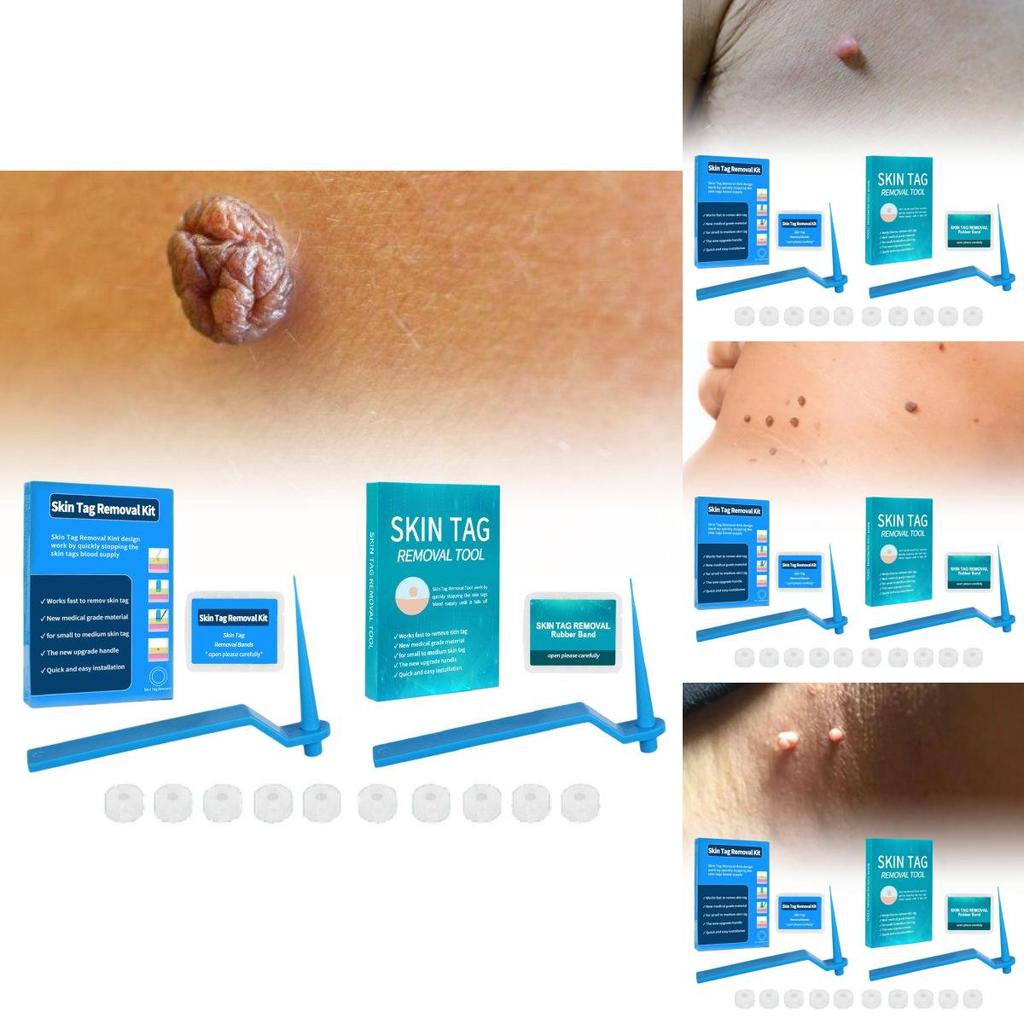 Effective Skin Tag Removal Tag Refill Band Set With 10 Pieces For Smooth Skin
