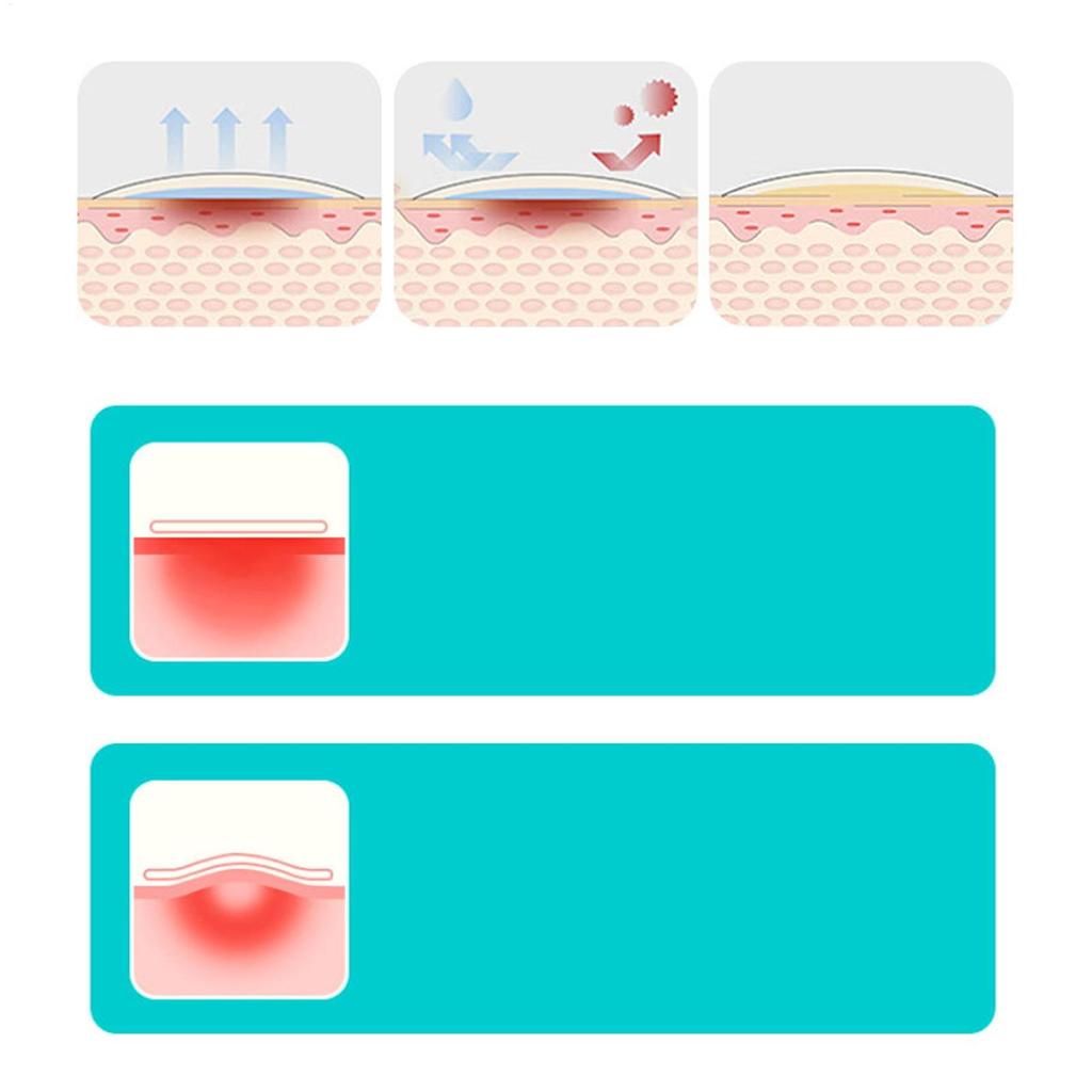 5x30cm Burn Hydrocolloid Roll for Wound Care Hydrocolloid Patch Bandages With Self-Adhesive Bed Sore Bandages, Highly Absorbent