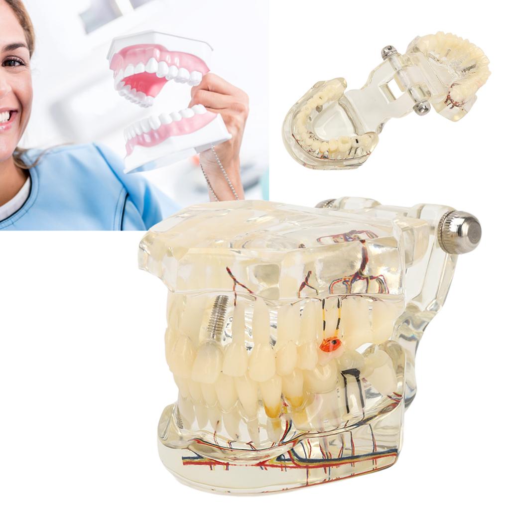 Transparent Dental Implant Pathological Model Implant Disease Teeth Model for Teaching Demonstration