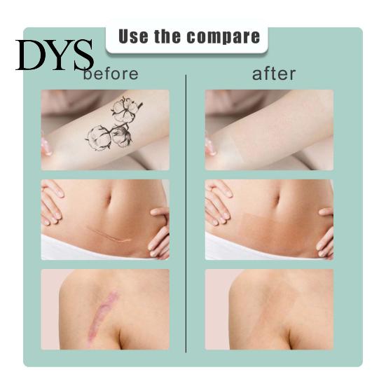 Acne Remover 50g/Box Tattoo Spot Concealer Portable Mild Waterproof Safe Painless Hide Spots Cream Flaws Non Woven Fabric Scar Care Sheet Sticker for