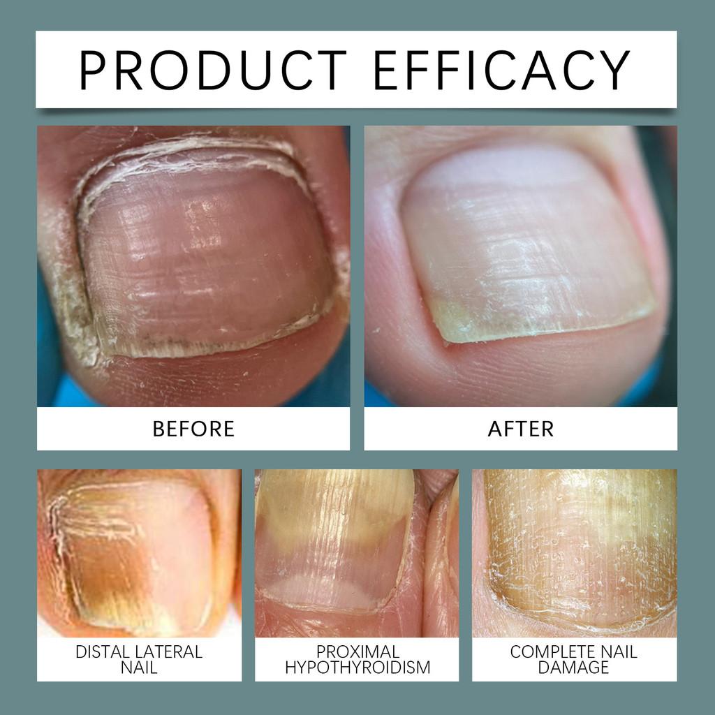 Ximonth Spray Soin des Ongles Formule Hydratante Pour des Ongles et des Cuticules Sains et Lisses