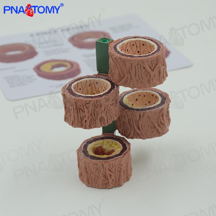 Atherosclerosis Demonstration Model: Four-Stage Arterial Hardening Teaching Aid 14×5×5 cm / 5.5×2.0×2.0 in