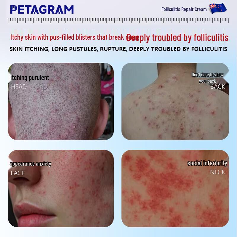 PETAGRAM Крем для лечения фолликулита и акне 20g