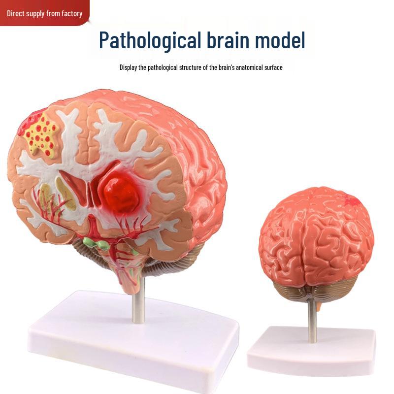 Human Brain Pathology Anatomy Model: Neurology & Cerebrovascular Occlusion Specimen