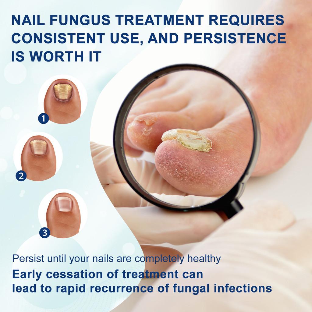 South Moon Nail Repair Pen Nourishing And Cleansing Solution For Thick And Brittle Nails