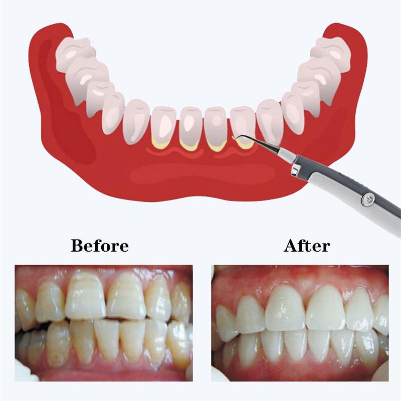 Přenosný elektrický ultrazvukový sonický pic zubní odstraňovač zubního kamene čistič zubních skvrn nástroj na zubní kámen odstraňování zubního kamene