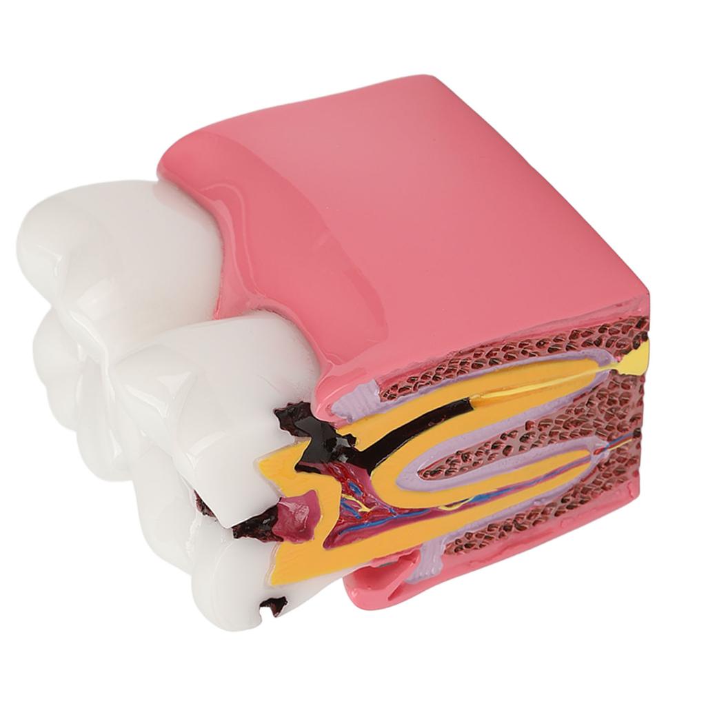 Dental Caries Model Tooth 6X Decay Demonstration Model for Teaching Study Laboratories