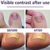 50Pcs Ingrown Toenail Corrector Sticker Nail Strip Anti-Roll Nail Free Glue Toe Inlay Nail Corrector Patch Correction Stickers