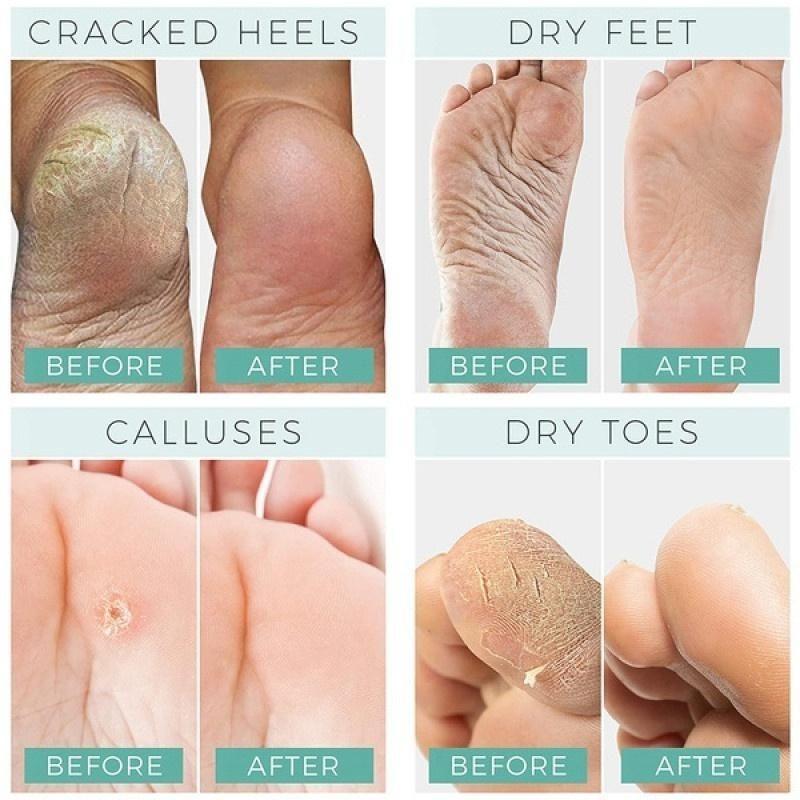 Cracked Repair Remove Callus Dead Skin Care Anti-dry Mask Exfoliating Socks Feet Care Foot Treatment