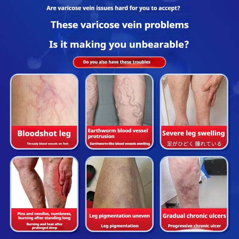 Varicose Veins Special Plaster Cold Compress Gel Earthworm Legs Old Rotten Legs Vascular Blockage Dredging Imported Medicine