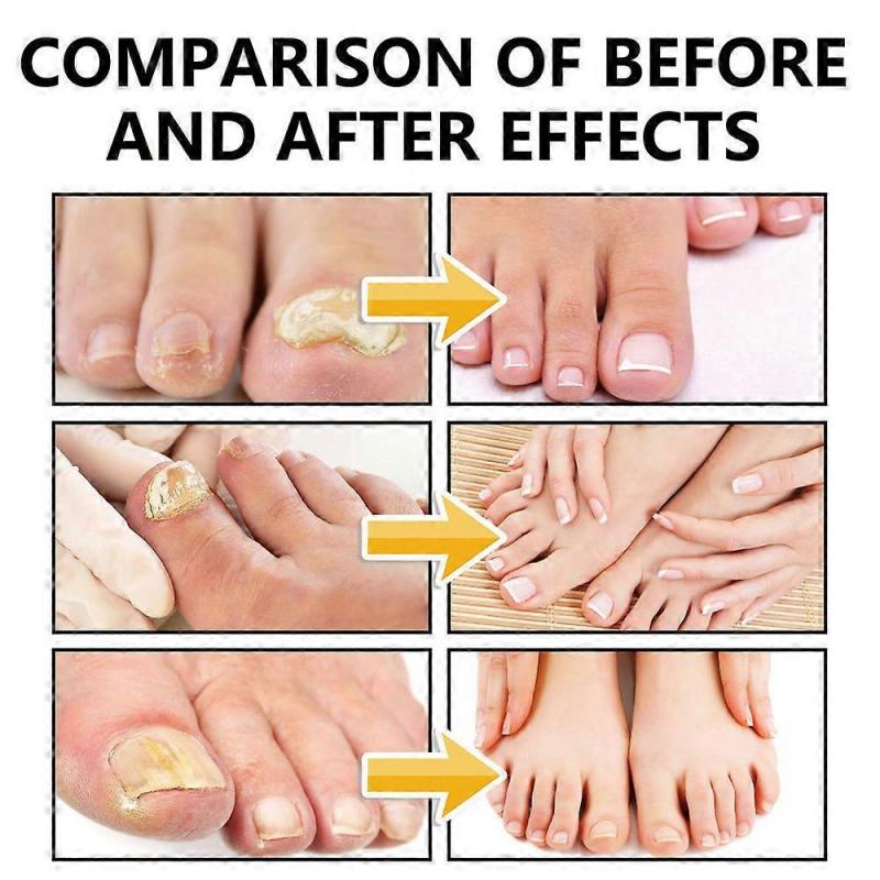 2025 Latest Model Nail Fungus Spray, Foot Moss Relief Deodorizing Odor Removal new