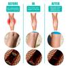 12Pcs Leg Varicose Patch Natural Healthy Herbal Extracts Varicose Vein Health Care Paste for Unisex