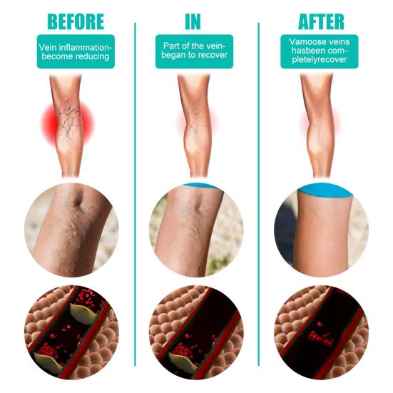 12Pcs Leg Varicose Patch Natural Healthy Herbal Extracts Varicose Vein Health Care Paste for Unisex