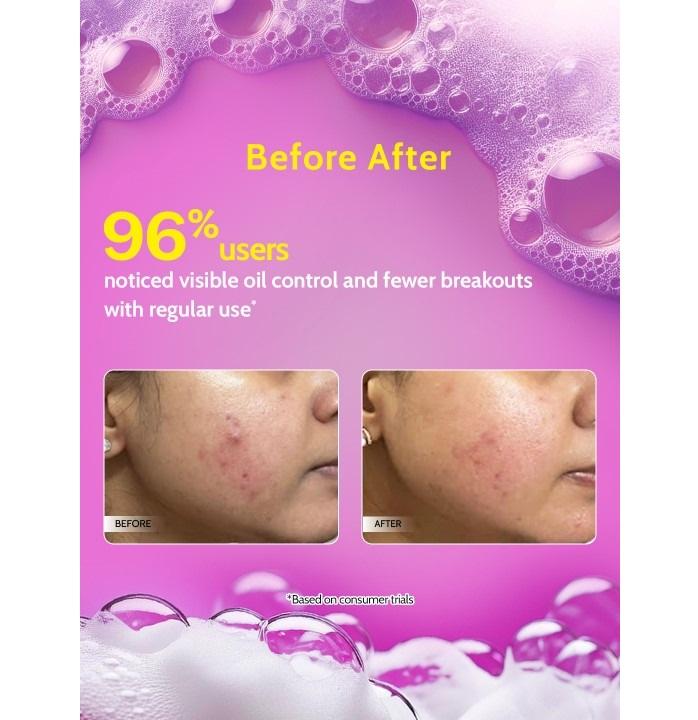 2% Salicylic Acid Oil & Acne Control Face Wash with Azelaic Acid - 100 ml