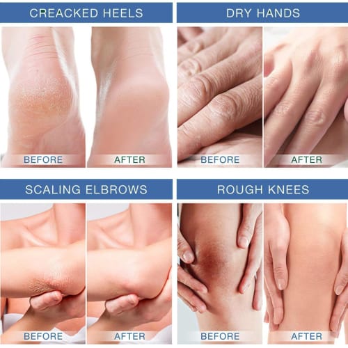 Rosarden Foot Cream & Lotion - Dry Foot Cream - Dry Foot Cream - Dry Foot Lotion - Foot Heal Cream - Foot Lotion for Dry Feet