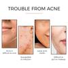 Acne Pimple Patch Repair Facial Acne Acne Cover Acne Smooth Skin Care Pimple Patch Mild Non-Irritating Skin