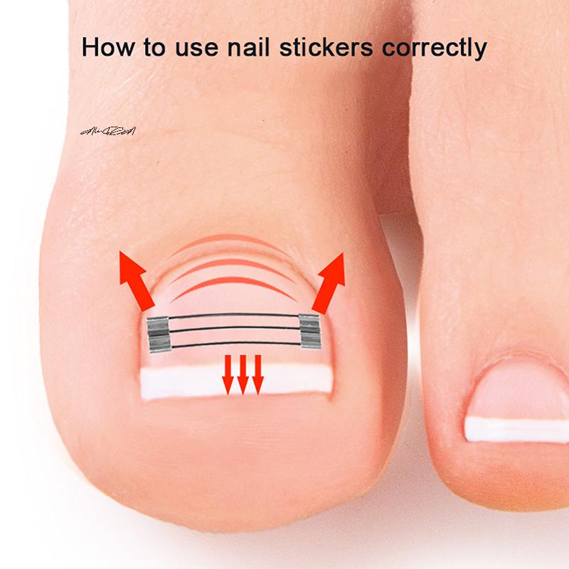 1 Set Professioneller eingewachsener Zehennagel Korrekturclip Spange Pediküre Erholungswerkzeug zur Zehennagelbehandlung Einwachsen Begradigungswerkzeug