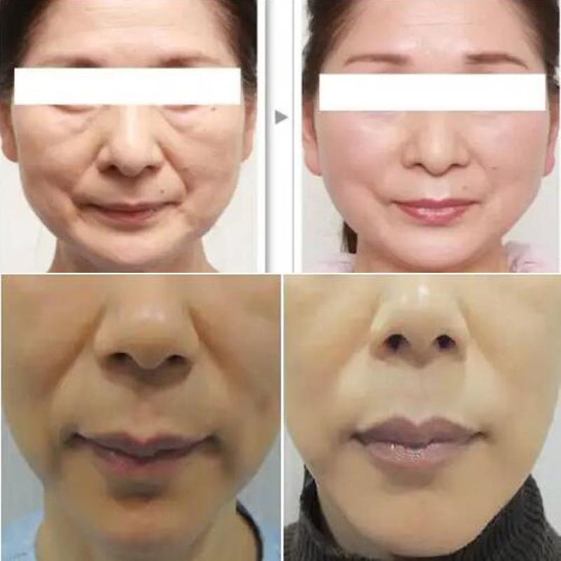 New Protein Thread Lifting Anti Wrinkle for Face Lift Gold Face Serum Collagen Silk Thread Nano Gold Essence Sets