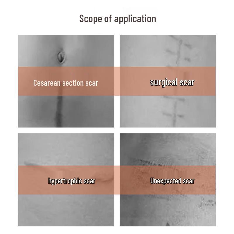 Shunaimi Silicone Gel Scar Sheet: High Elastic, Breathable, Reusable Adhesive Patch for Hypertrophic Scars.