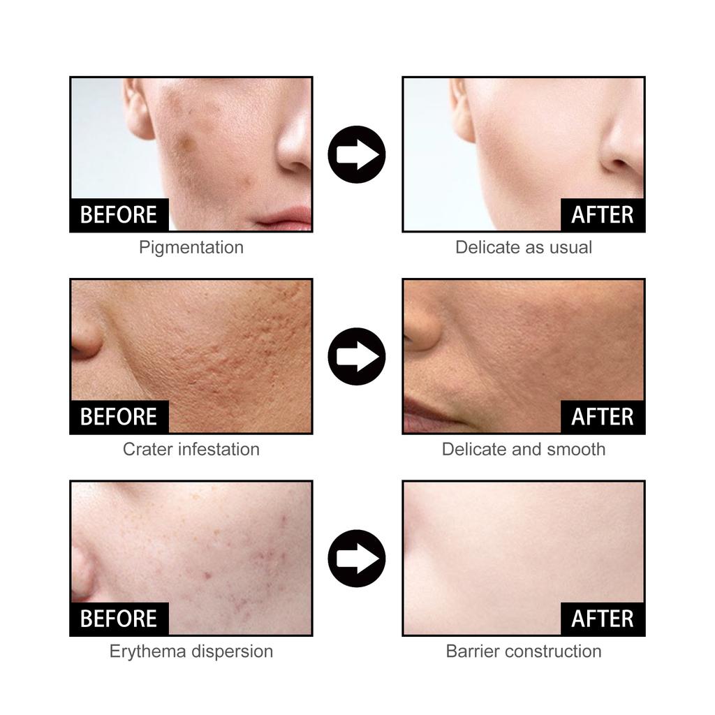 EELHOE Niacinamide Face Serum Whitening Anti Wrinkles Removal Spots Freckle Face Care Sodium Hyaluronate Facial Essence 50ml