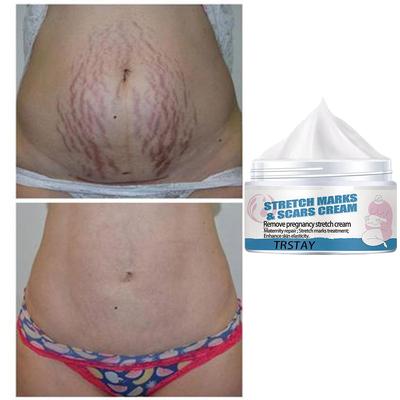Mulher grávida creme reparador de estrias pós-parto e estrias desbotadas