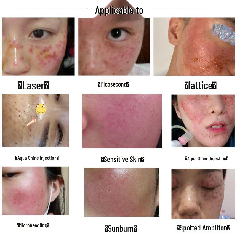 Beauty Salon Blue Copper Peptide Microneedle Acne Repair Set - 80,000 Activity Polypeptide Freeze-Dried Powder