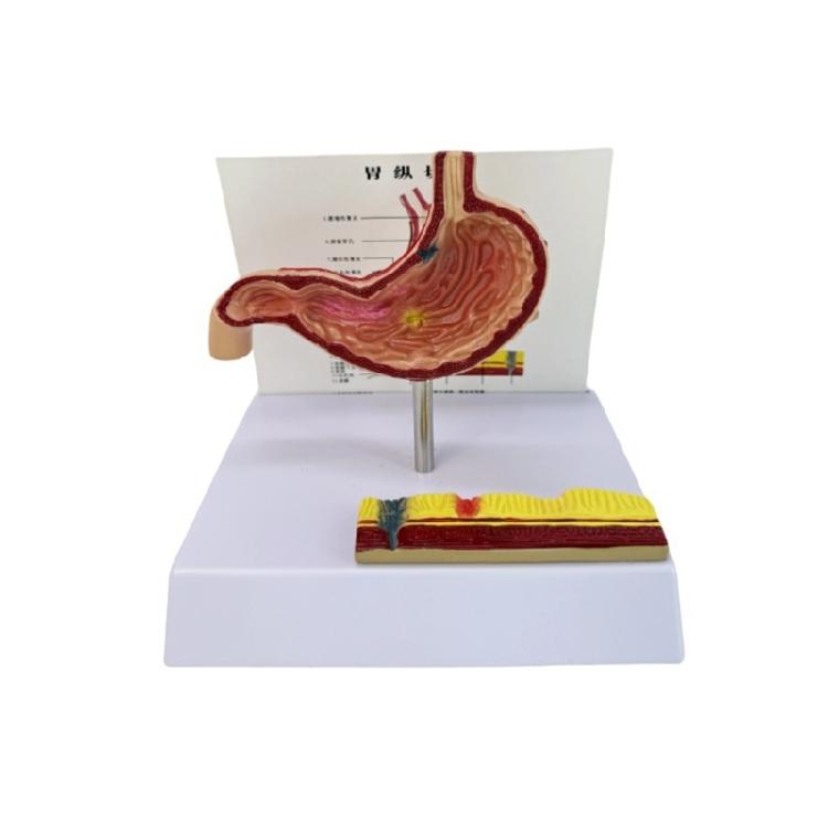 Pathological Stomach Anatomy Model Anatomical Gastric Perforation Model Classroom Teaching Tool for Clinical Setting 1