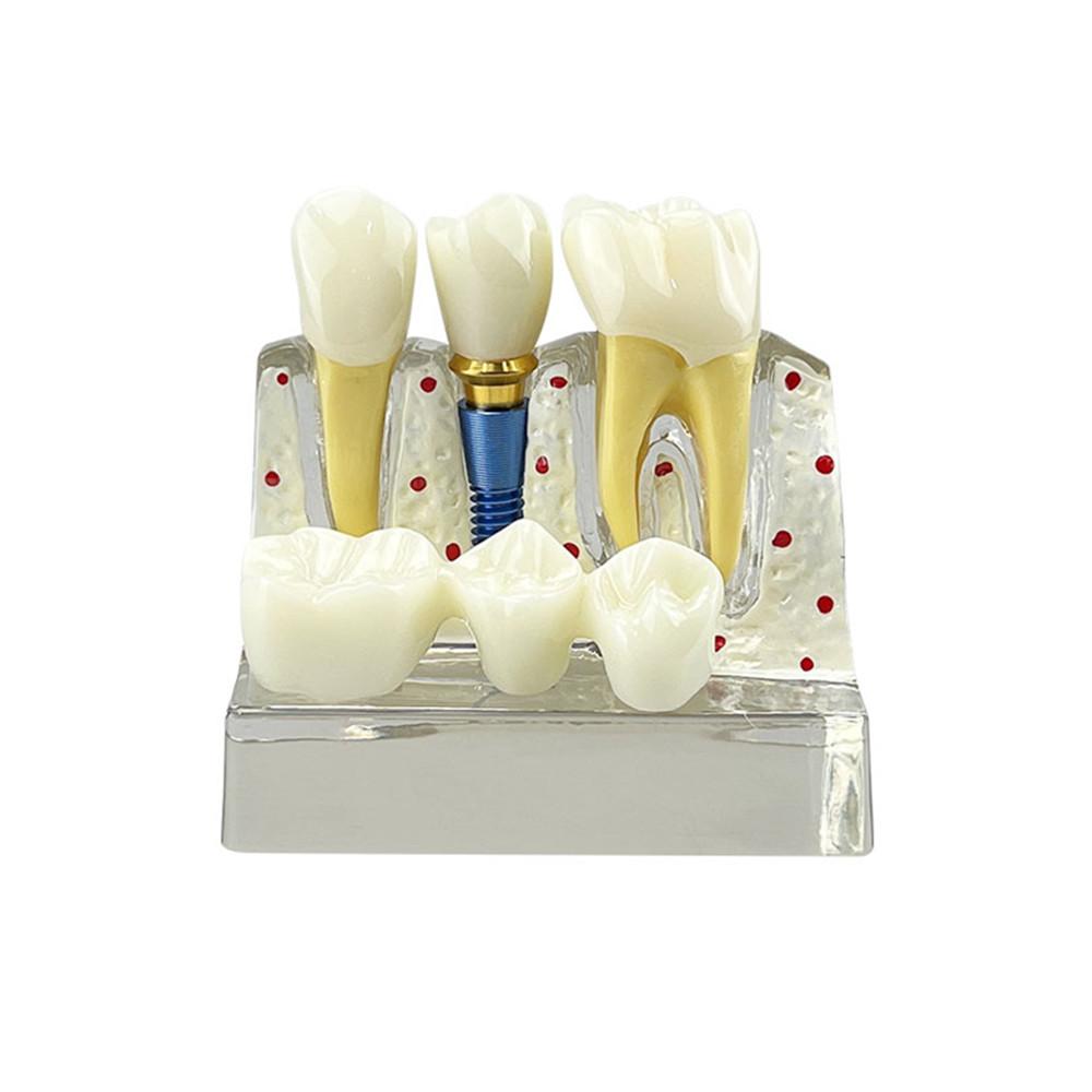 Modello Dimostrativo di Impianti Dentali 4 Volte Denti Analisi Impianti Corona Ponte Modello Rimovibile Per Studenti Dentisti Insegnamento Studio