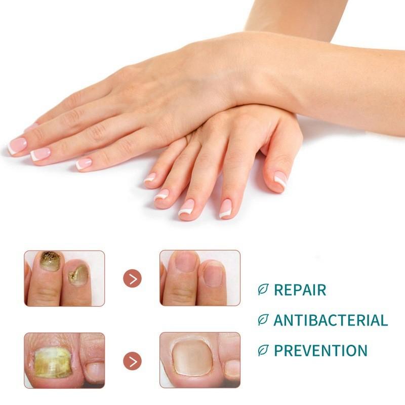 Jaysuing Nährende Nagelreparatur-Pflaster für starke und gesunde Nägel mit Weichgel-Formel