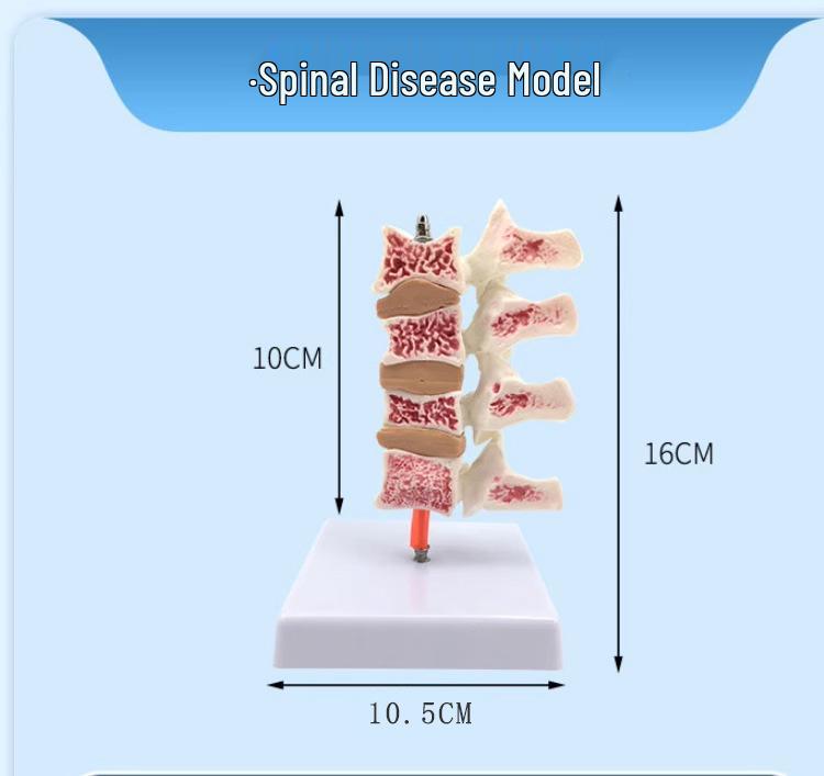 Human Femur Osteoporosis Model with Lumbar Vertebrae Pathology